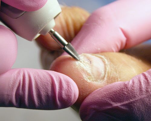 Обработка инфицированной/утолщенной ногтевой пластины Baring
